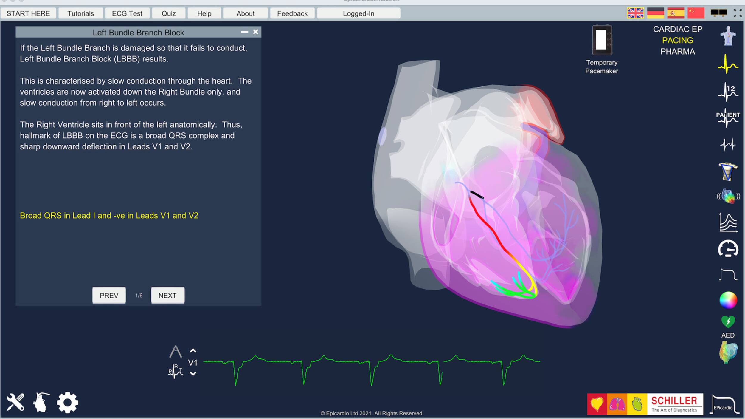 Epicardio ECG Simulation, left bundle branch block | © Epicardio