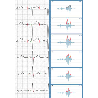 Non-invasive diagnosis of ischaemic heart disease