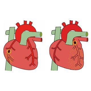 Culprit Coronary Artery Algorithm